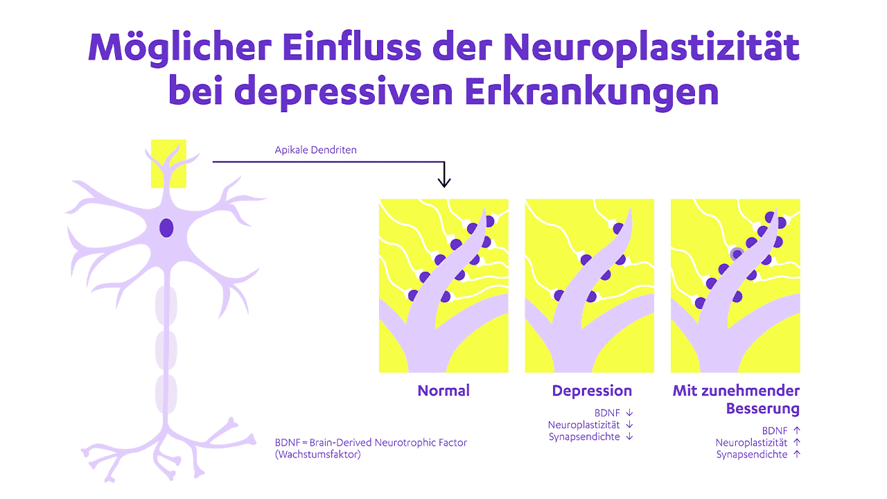 Abbildung zum möglichen Einfluss der Neuroplastizität bei depressiven Erkrankungen - Initiative #GemeinsamGegenDepression