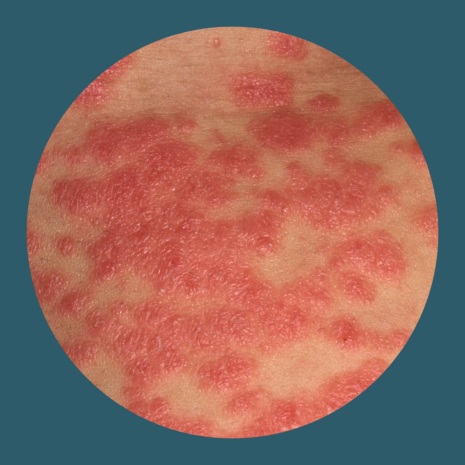 Psoriasis: Ursachen & Symptome Der Schuppenflechte | JanssenWithMe