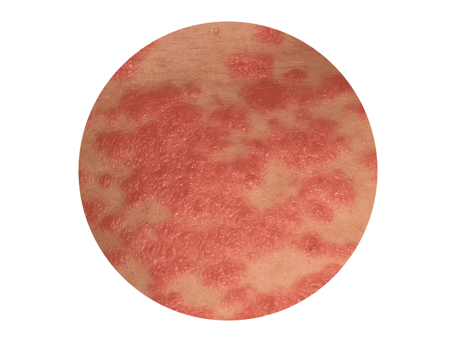 Starkt gerötete, verbrennungsähnliche Schuppen bei der erythrodermischen Psoriasis