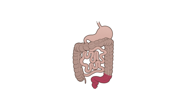 Abbildung des Krankheitsbilds Colitis ulcerosa