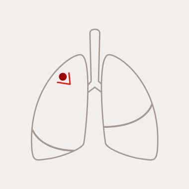 Atypische Resektion Atypische Resektion