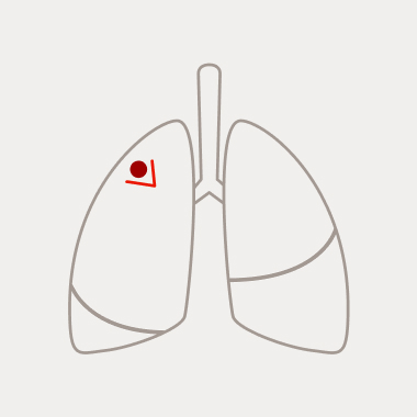 Schematische Darstellung einer Keilresektion mit Tumor und keilförmiger Entfernung im linken Lungenflügel.