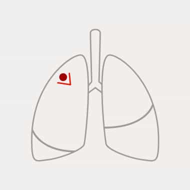 Schematische Darstellung einer atypischen Resektion Schematische Darstellung einer Keilresektion mit Tumor und keilförmiger Entfernung im linken Lungenflügel.