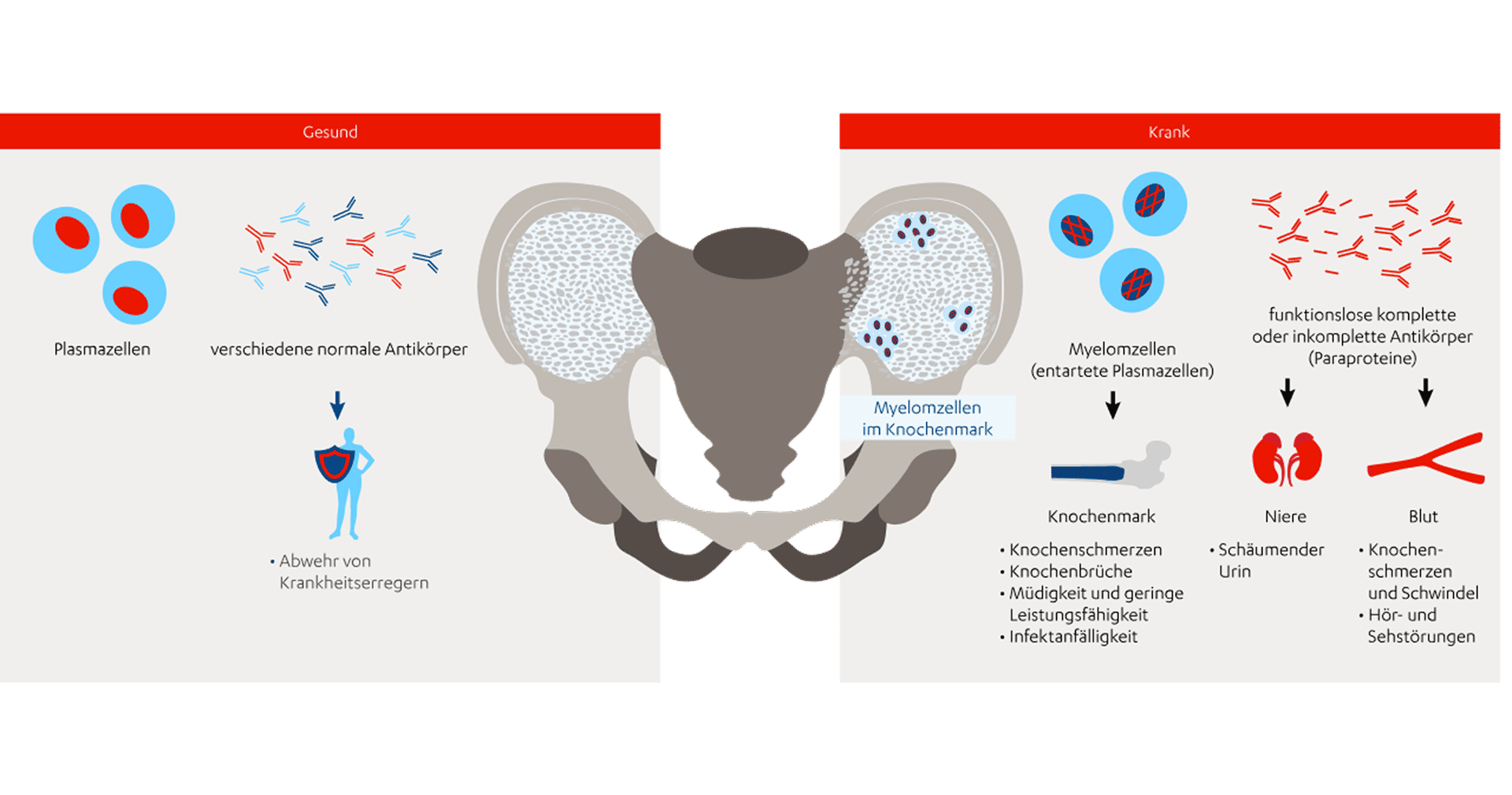 Multiples Myelom Symptome Lebenserwartung Therapie J J WithMe multiples-myelom-symptome-lebenserwartung-therapie-j-j-withme