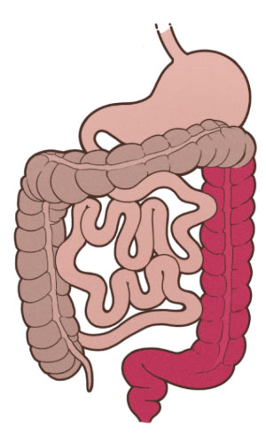 Zeichnung des Magen-Darm-Traktes mit roter Färbung des Dick- und Enddarms bis zur linken Krümmung. Nur dieser Teil des Darms ist bei der Linksseitencolitis entzündet. Diese Teile sind der bei der Proktitis 