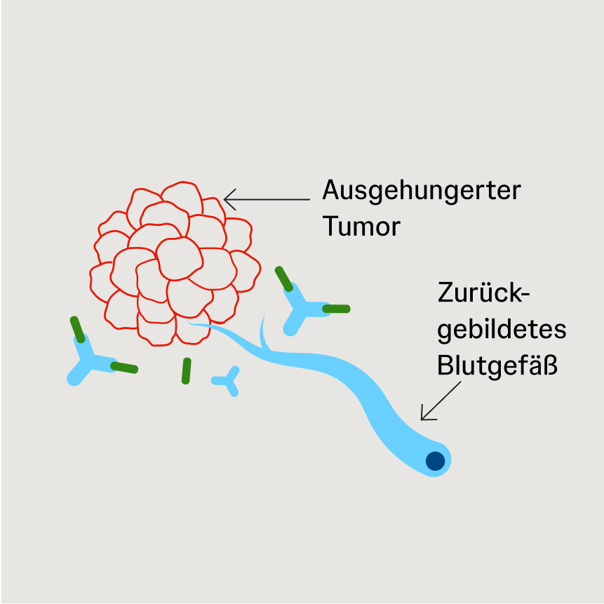 Schematische Darstellung eines ausgehungerten Tumors mit Rückbildung von Blutgefäßen durch Angiogenese-Inhibitoren.