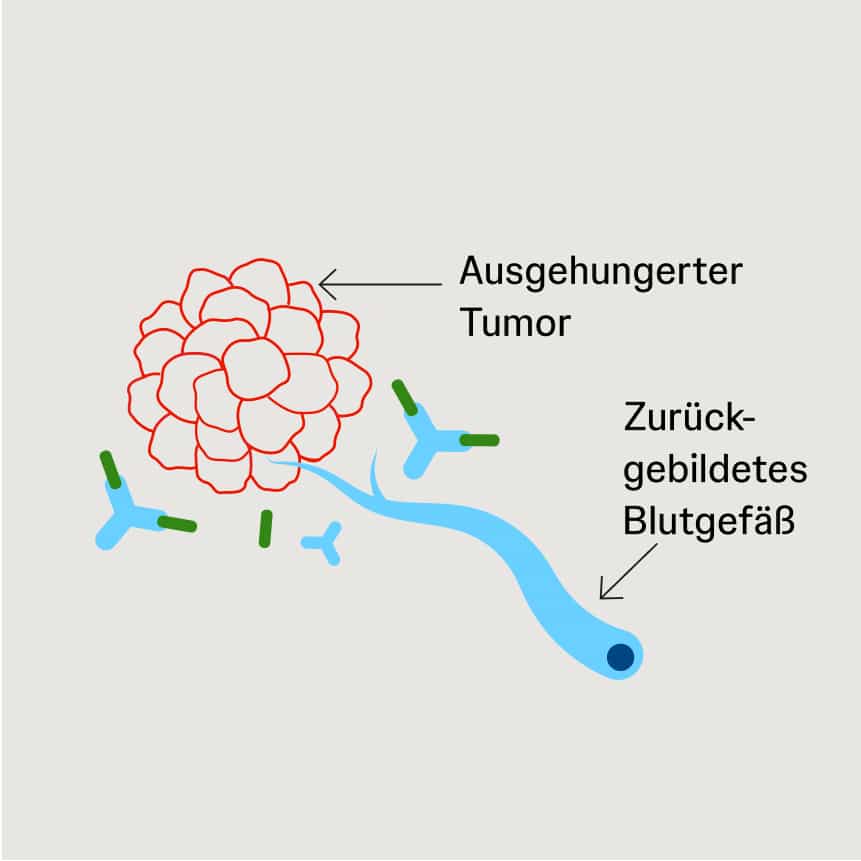 Rückbildung von Blutgefäßen im Tumor durch Therapie Schematische Darstellung eines ausgehungerten Tumors mit Rückbildung von Blutgefäßen durch Angiogenese-Inhibitoren.