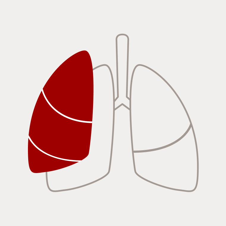 Schematische Darstellung einer Pneumektomie mit Entfernung des gesamten linken Lungenflügels.
