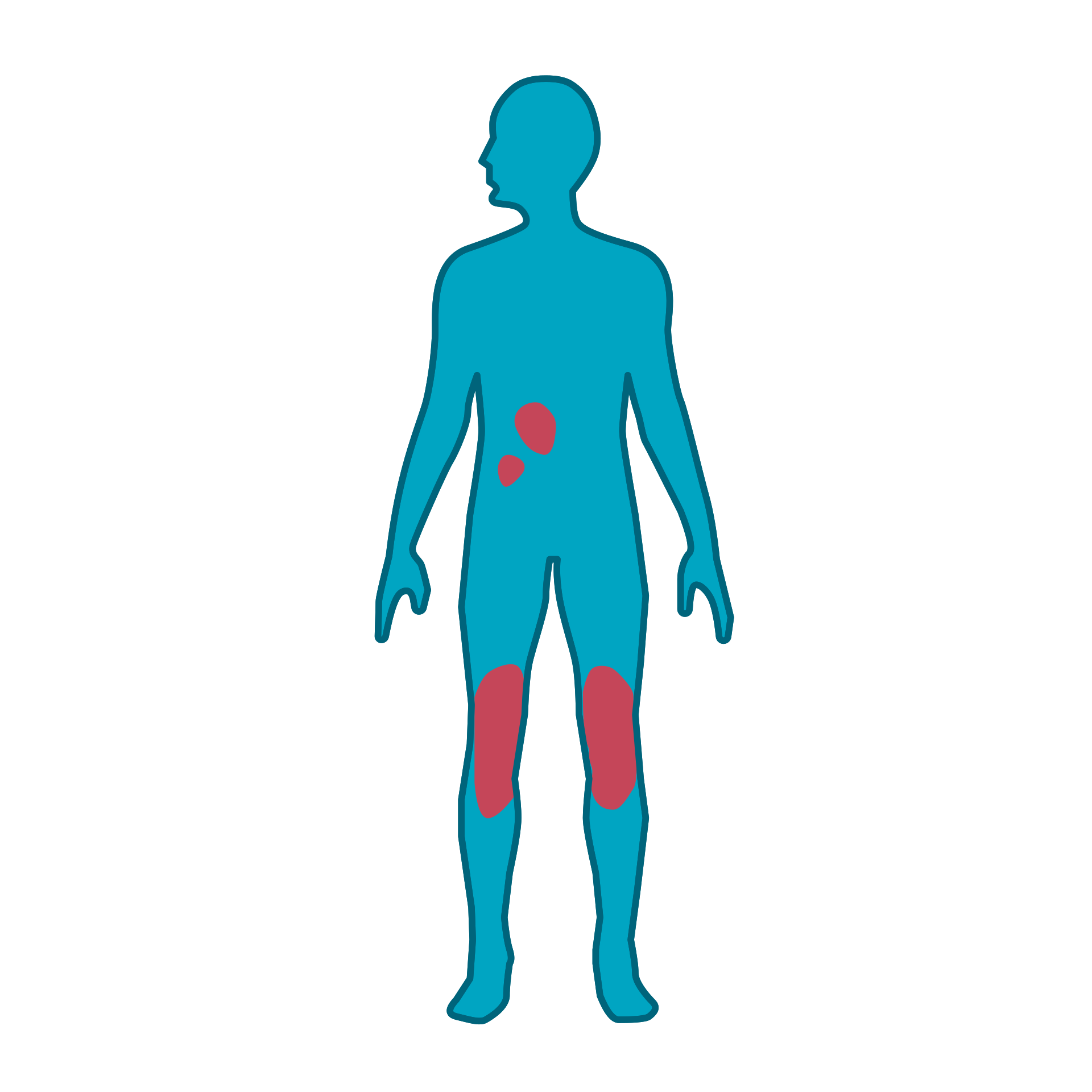 Mensch mit Psoriasis-Plaques an Beinen und Rumpf