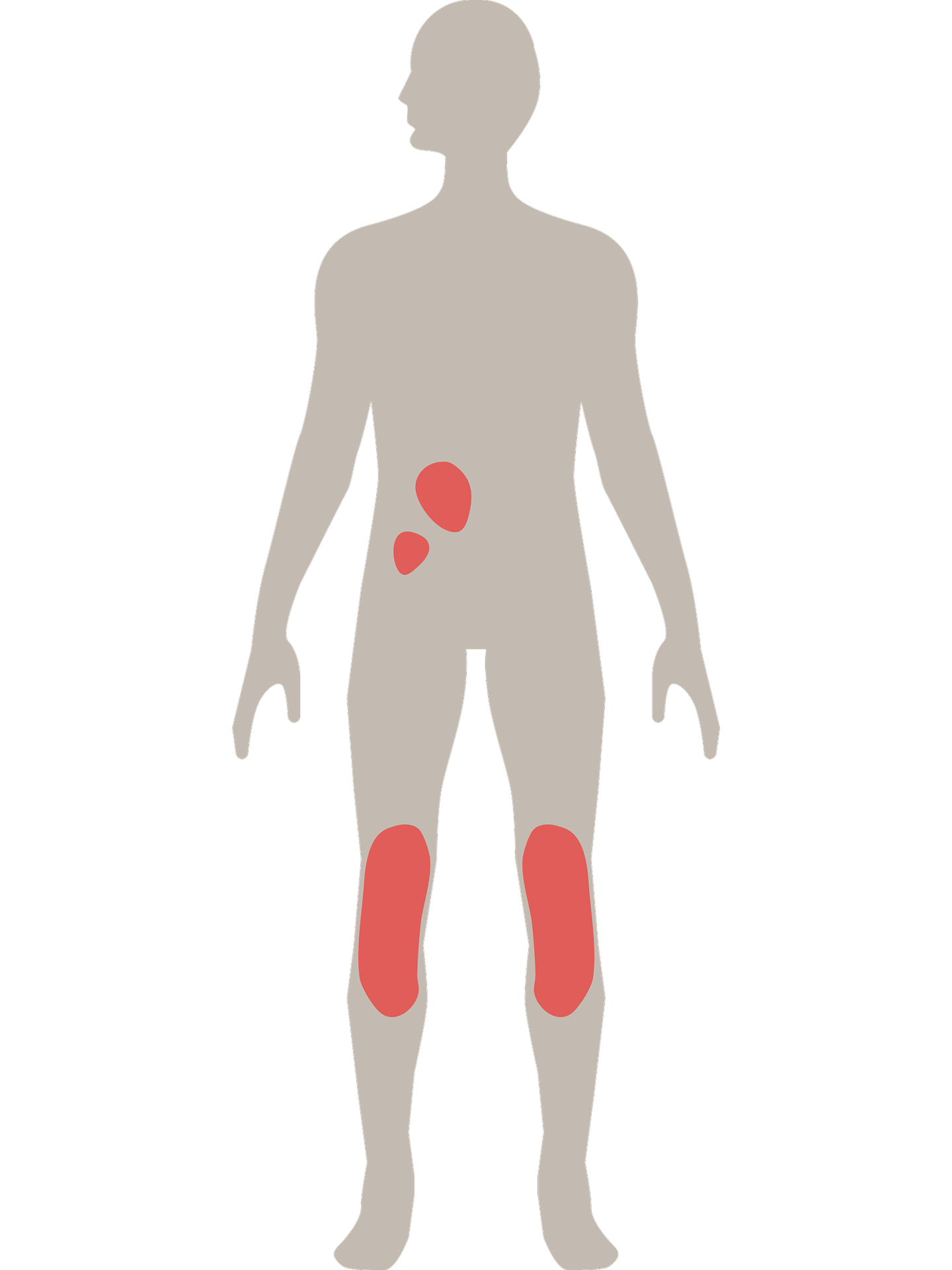 Mensch mit Psoriasis-Plaques an Beinen und Rumpf