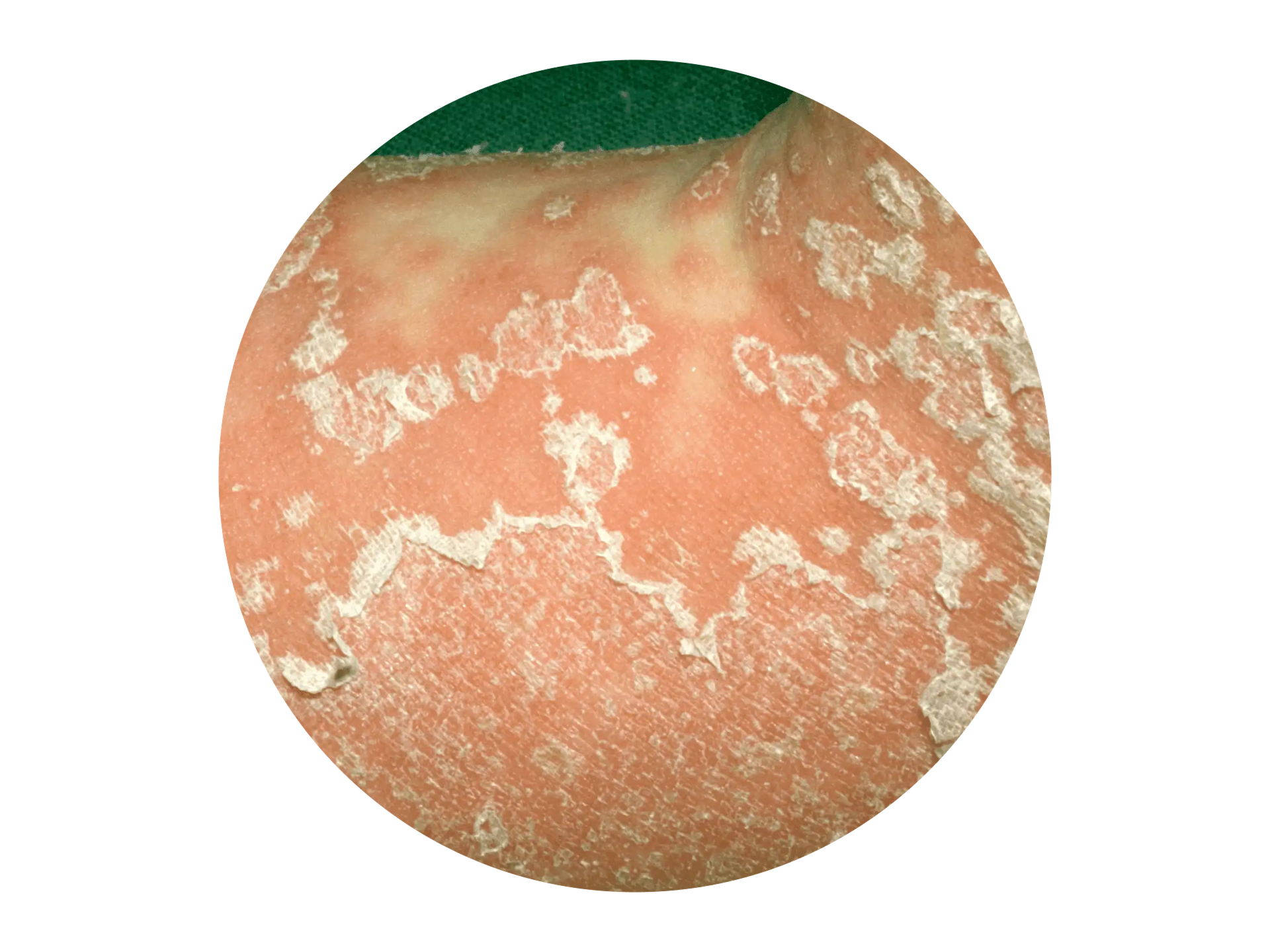 Weiße, eitrige Pusteln am Fuß eines Menschen mit Psoriasis Pustulosa