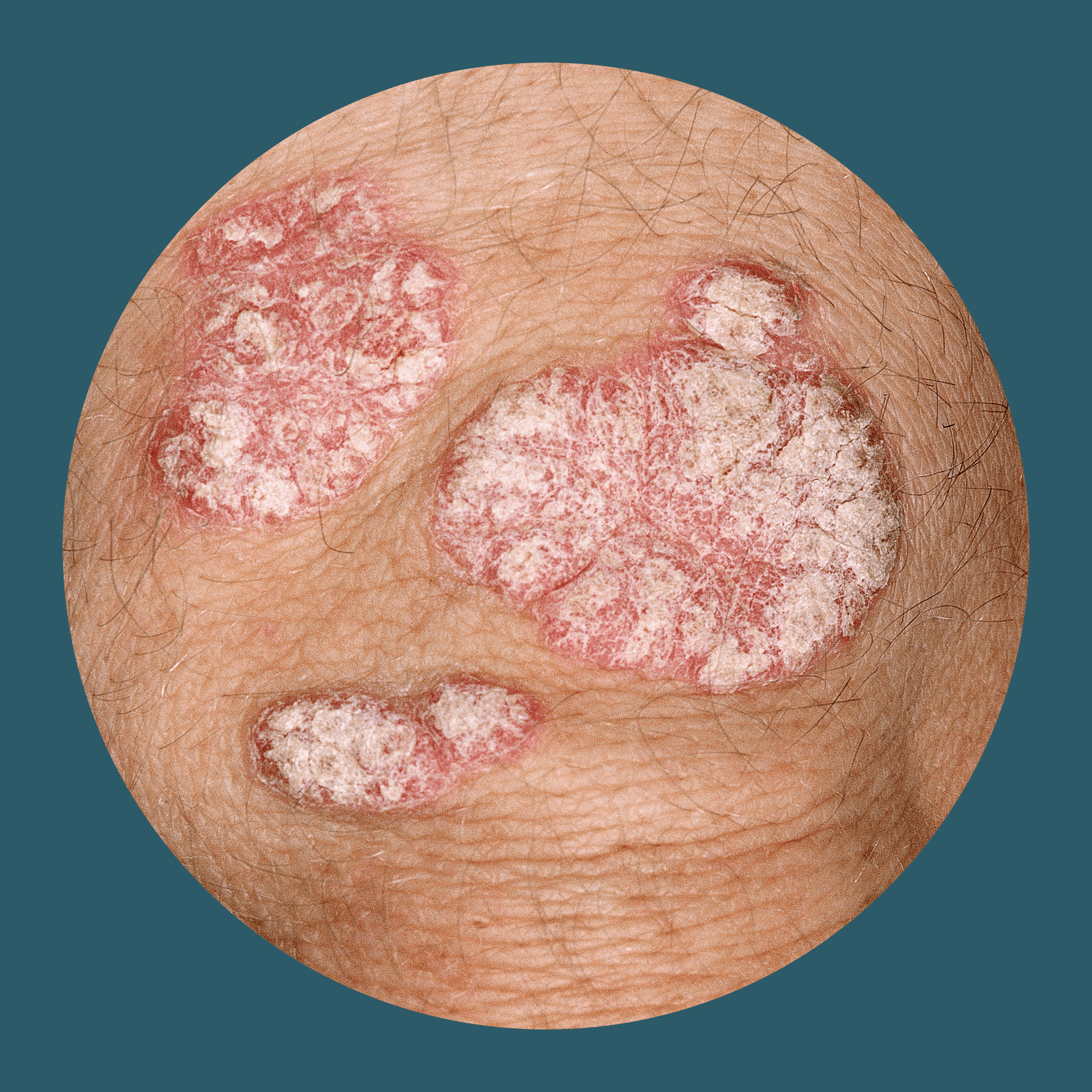 Psoriasis: Ursachen & Symptome Der Schuppenflechte | JanssenWithMe