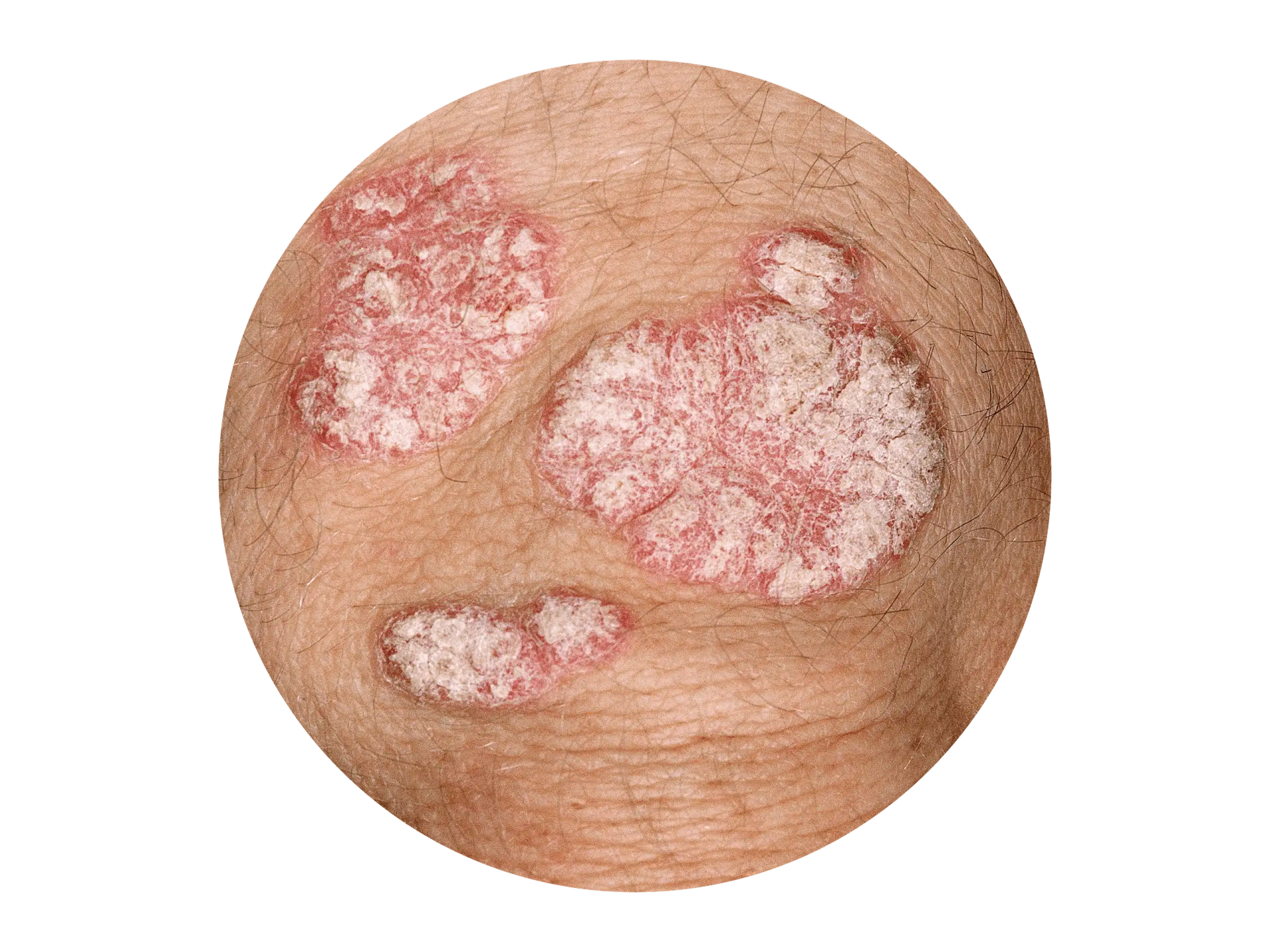 Silbrige Psoriasis-Schuppen am Ellbogen