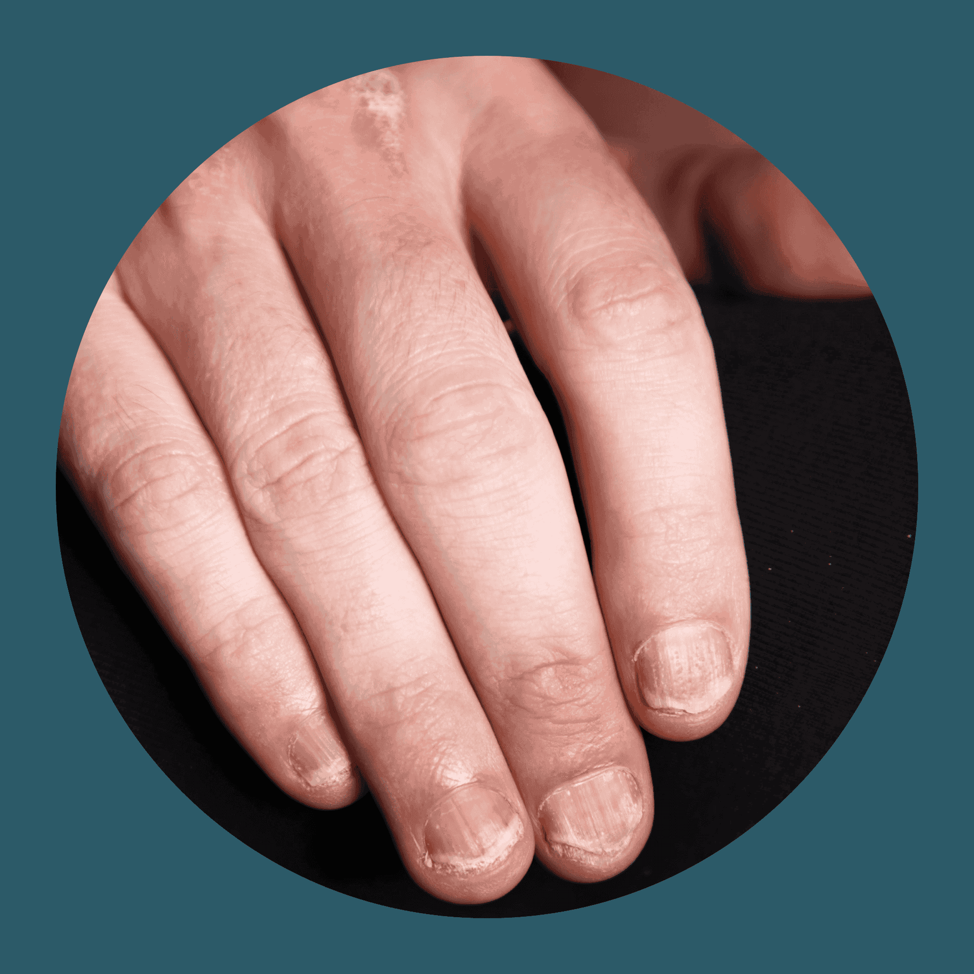 Hand einer Person, die von Nagel-Psoriasis betroffen ist und beschädigte Fingernägel hat