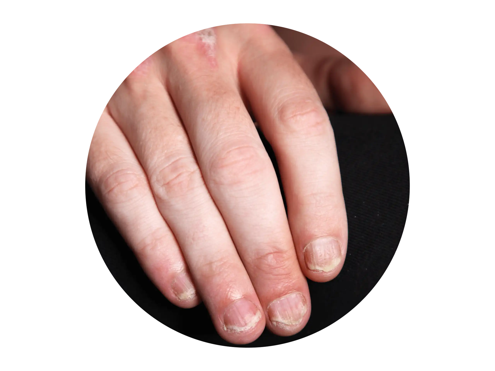 Hand einer Person, die von Nagel-Psoriasis betroffen ist und beschädigte Fingernägel hat Hand einer Person, die von Nagel-Psoriasis betroffen ist und beschädigte Fingernägel hat