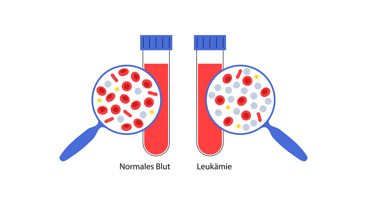 Petechien bei Leukämie: Veränderungen im Blut einfach erklärt Illustration zum Vergleich von normalem Blut und Blut bei Leukämie mit veränderten Blutzellen