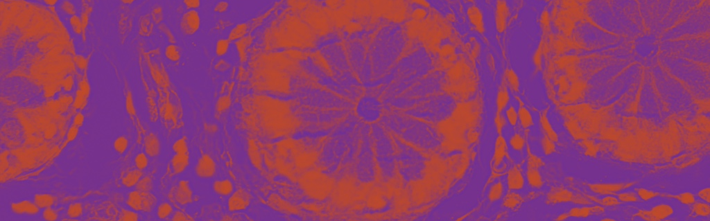 Podcasten om inflammatorisk tarmsygdom