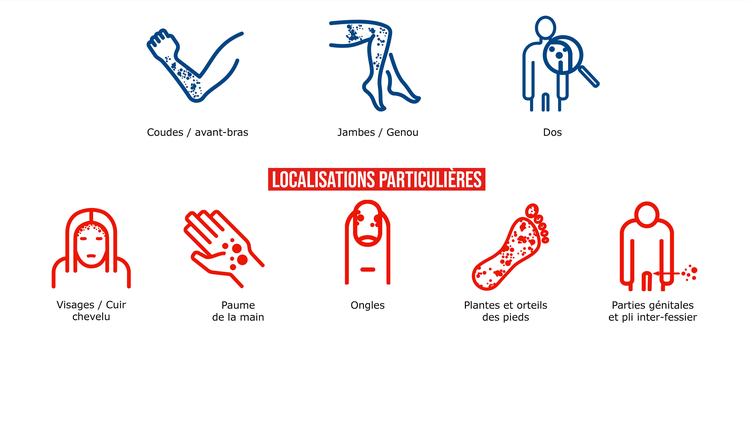 Qu’est-ce que le Psoriasis-col-image