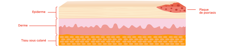 Décrypter les biothérapies - Biothérapies-Qu’est-ce que le Psoriasis-image2