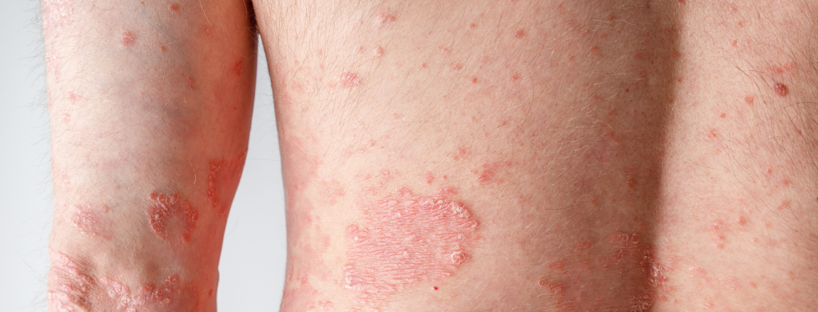 Décrypter les biothérapies - Biothérapies-Qu’est-ce que le Psoriasis-image