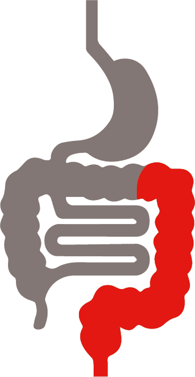 Die Lokalisation von Colitis ulcerosa Die Lokalisation von Colitis ulcerosa