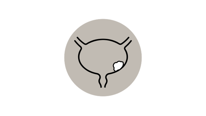 Neubildung eines Tumors