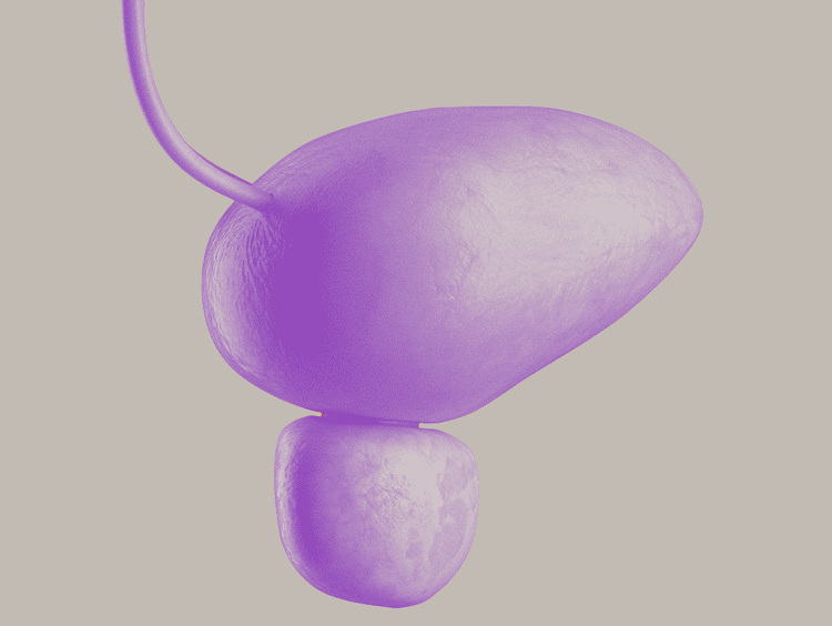 Urothelkarzinom – Informationen aus der Uroonkologie 3D-Illustration der Harnblase im Kontext von Uroonkologie und Urothelkarzinom (Blasenkarzinom)