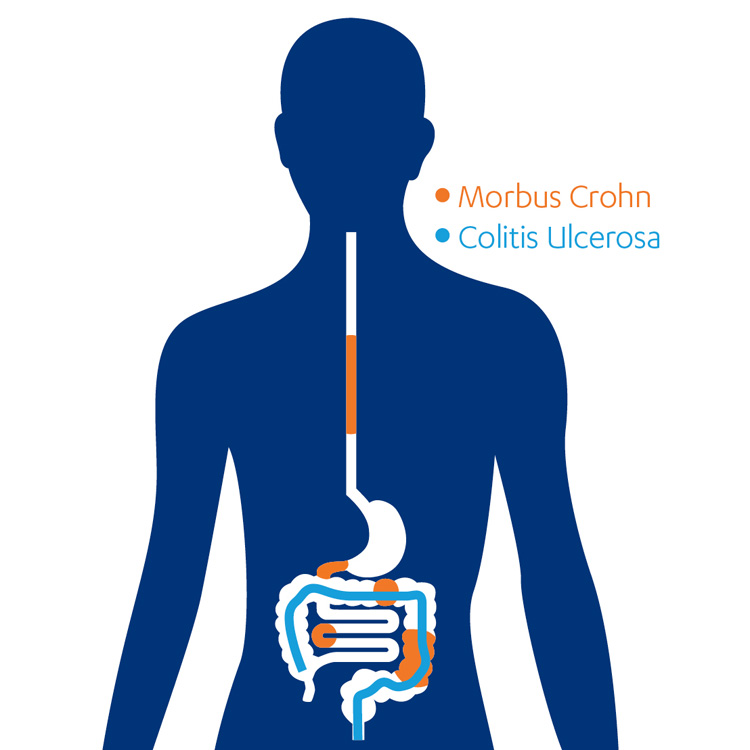 Unterschiedliche Lokalisationen von Morbus Crohn und Colitis ulcerosa