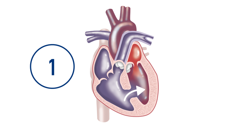 Darstellung des Herzens beim Eisenmenger-Syndrom