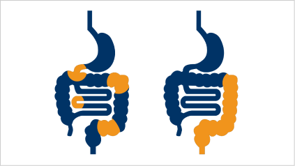 Magen-Darm-Trakt mit den Lokalisationen der von Morbus Crohn und Colitis ulcerosa betroffenen Regionen