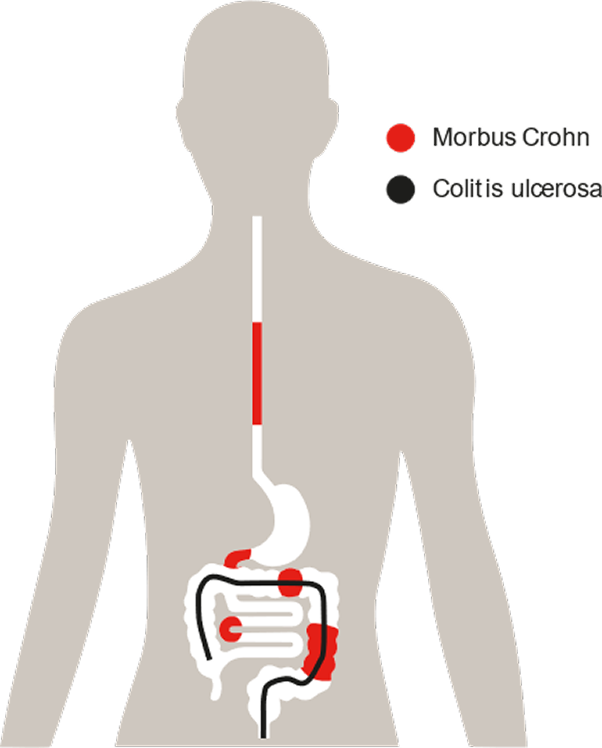 Schaubild: Unterschiedliche Lokalisationen von Morbus Crohn und Colitis ulcerosa