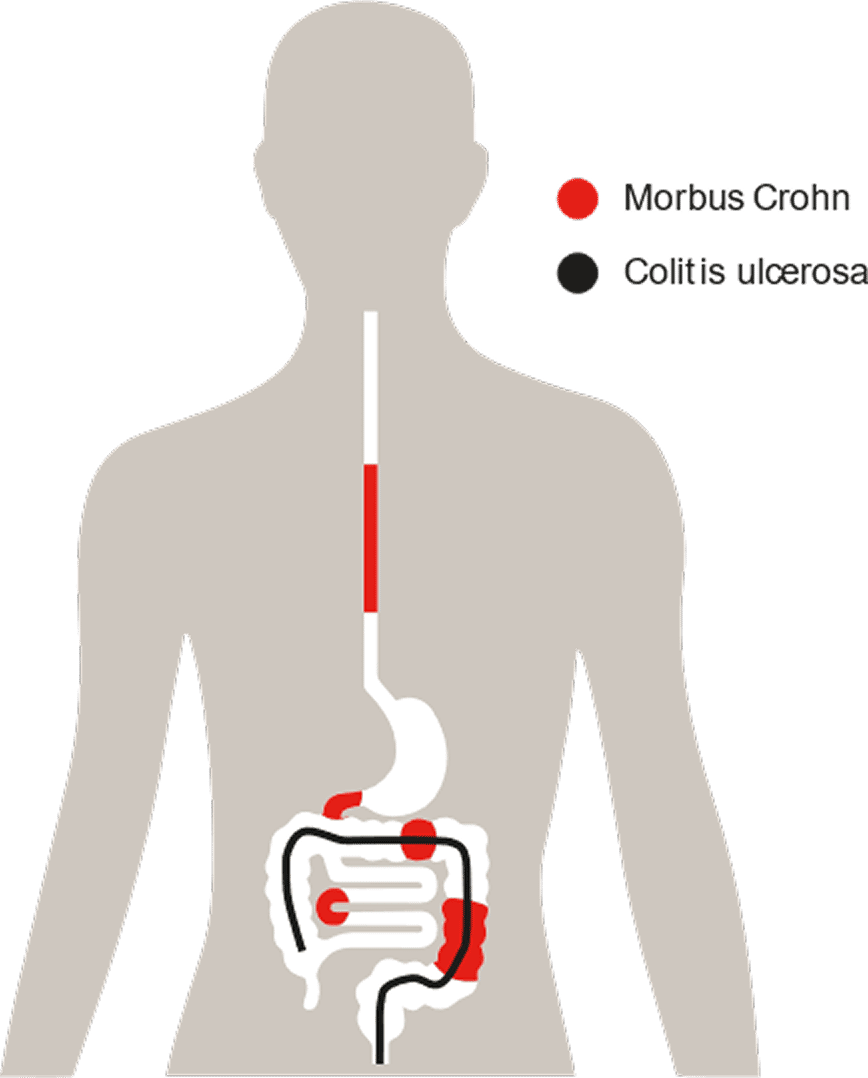 Schaubild: Unterschiedliche Lokalisationen von Morbus Crohn und Colitis ulcerosa Schaubild: Unterschiedliche Lokalisationen von Morbus Crohn und Colitis ulcerosa