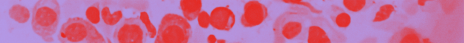 Mikroskopische Darstellung von Amyloidablagerungen bei AL-Amyloidose Amyloidablagerungen im Gewebe bei AL-Amyloidose