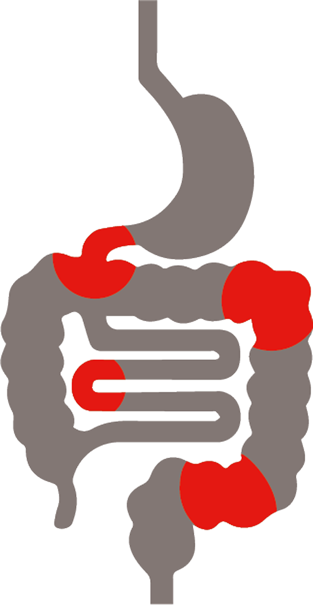 Die Lokalisation von Morbus Crohn