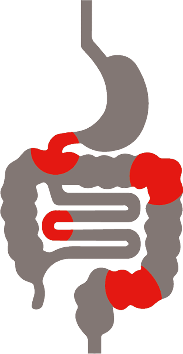 Die Lokalisation von Morbus Crohn Die Lokalisation von Morbus Crohn