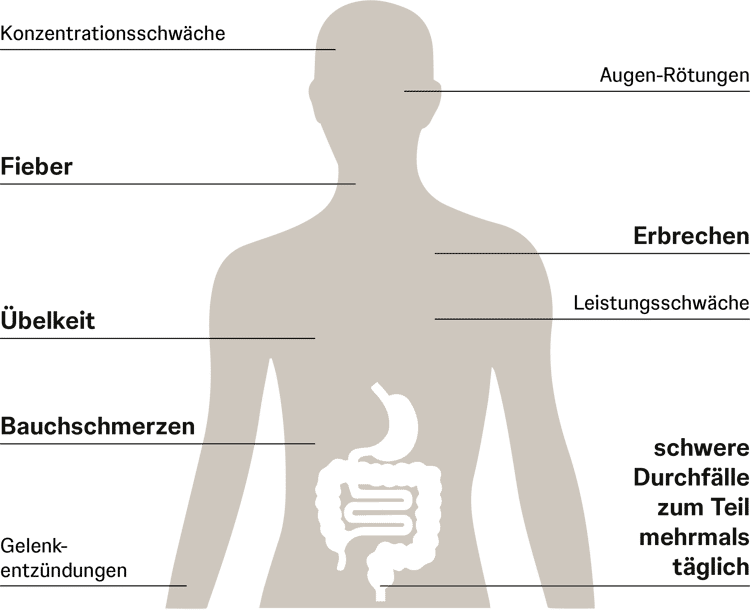 Schaubild mögliche Symptome bei Morbus Crohn & Colitis Ulcerosa Schaubild mögliche Symptome bei Morbus Crohn & Colitis Ulcerosa