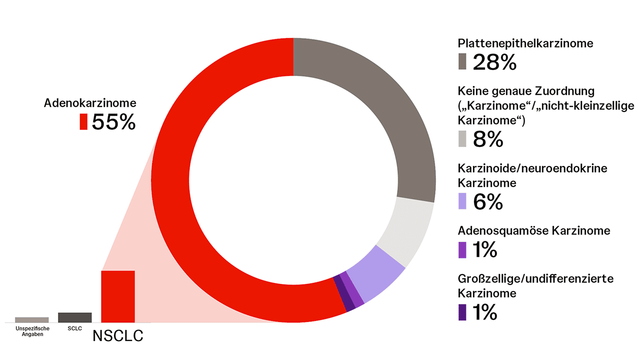 Häufigkeiten histologischer NSCLC-Subtypen in Deutschland Häufigkeiten histologischer NSCLC-Subtypen in Deutschland