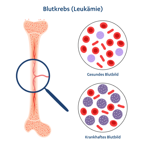 Unterschiede im Blutbild bei Leukämie