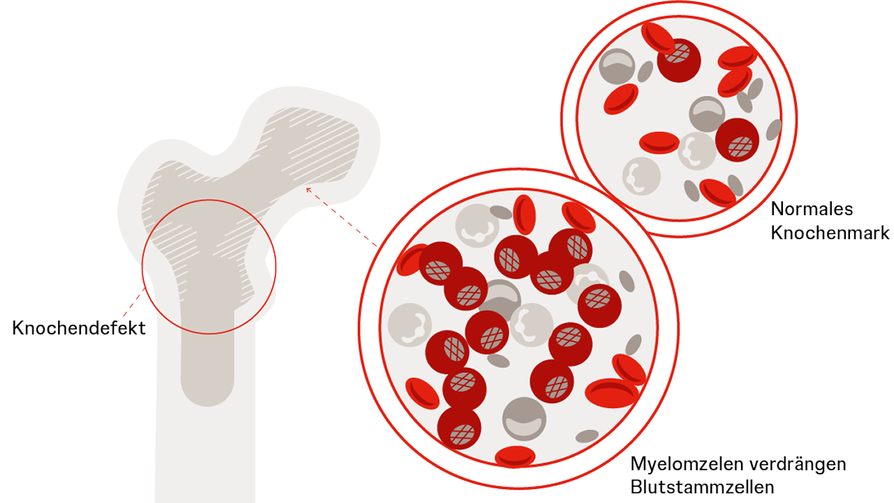 Unterschiede im Blutbild bei Leukämie