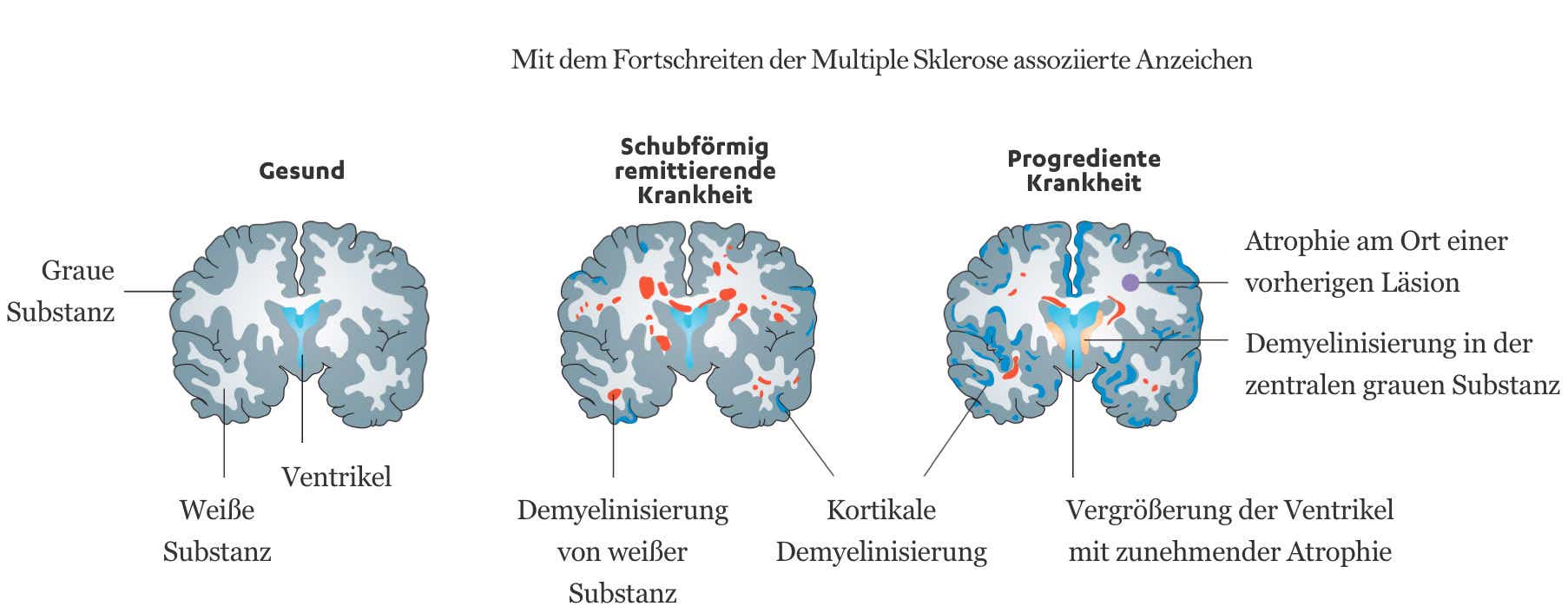 Stadien des Gehirns: 1. gesund, 2. bei schubförmig remittierender MS, 3. bei progredienter MS.