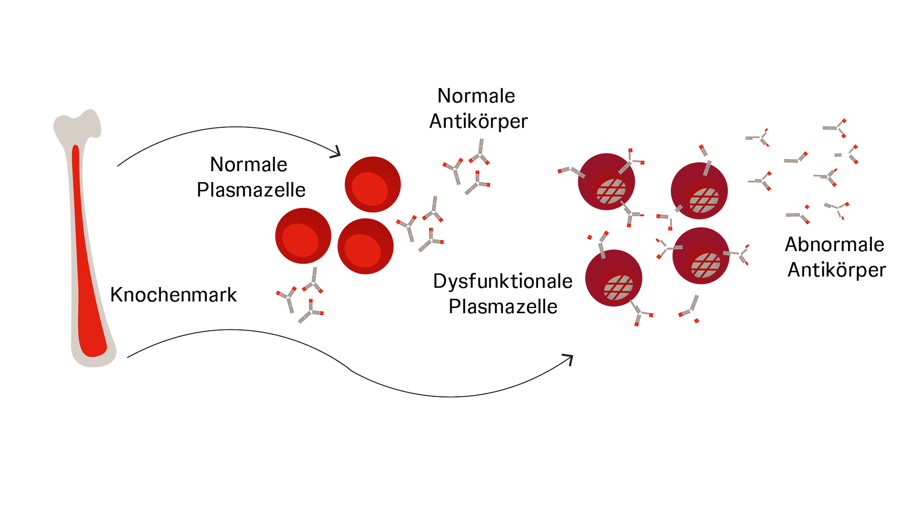 Knochenmark, aus dem sich unkontrolliert dysfunktionale Plasmazellen bilden, die abnorme Antikörper bilden
