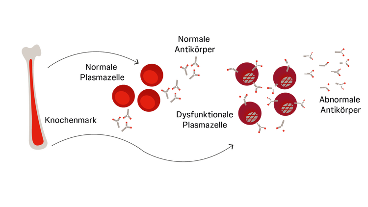 Knochenmark, aus dem sich unkontrolliert dysfunktionale Plasmazellen bilden, die abnorme Antikörper bilden