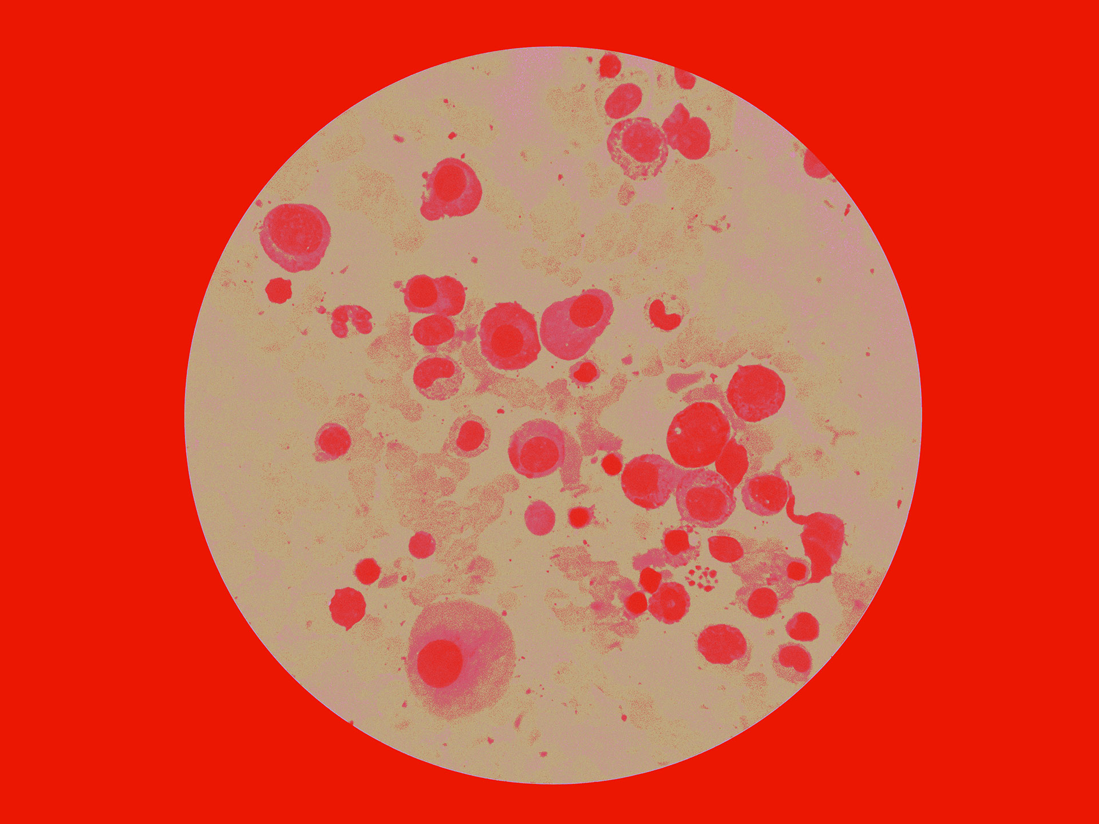 Smouldering Multiples Myelom (SMM)
