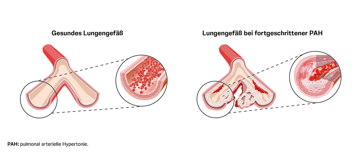 Vergleich eines gesunden Lungengefäßes mit einem durch PAH verengten Lungengefäß