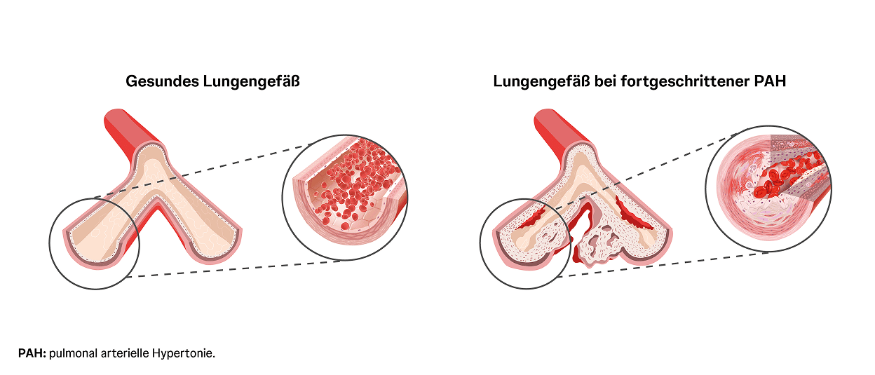 Lungengefäß bei PAH im Vergleich zum gesunden Gefäß Vergleich eines gesunden Lungengefäßes mit einem durch PAH verengten Lungengefäß