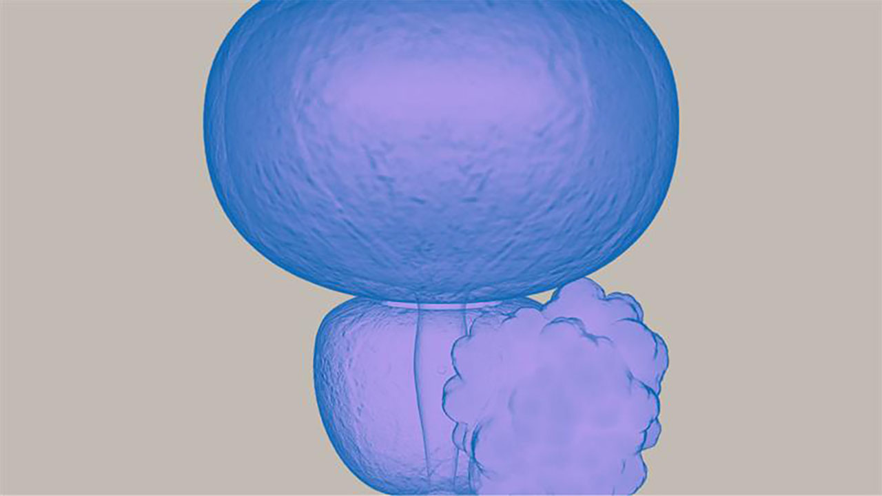 ta-uroonkologie-prostatakarzinom