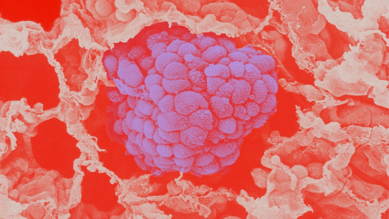 Mikroskopische Darstellung einer Lungenkrebszelle (violett) inmitten von gesundem Gewebe (rötlich-weiß). Die Illustration zeigt die komplexe Zellstruktur und dient zur Veranschaulichung onkologischer Prozesse.