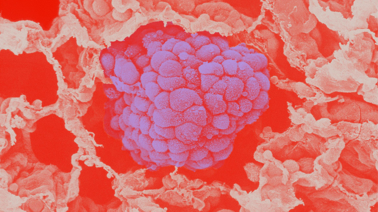 Mikroskopische Darstellung einer Lungenkrebszelle (violett) inmitten von gesundem Gewebe (rötlich-weiß). Die Illustration zeigt die komplexe Zellstruktur und dient zur Veranschaulichung onkologischer Prozesse.