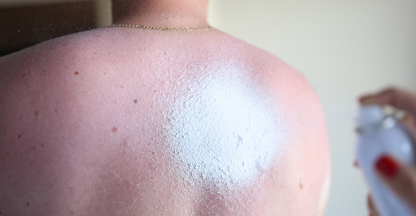 Apply sunburn cream on a man's burned back. Consequences of long exposure to the sun concept