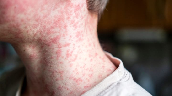 What happens when measles comes to your farm?